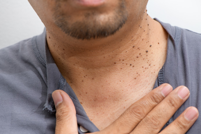 Eliminación de verrugas en el cuello de forma natural.